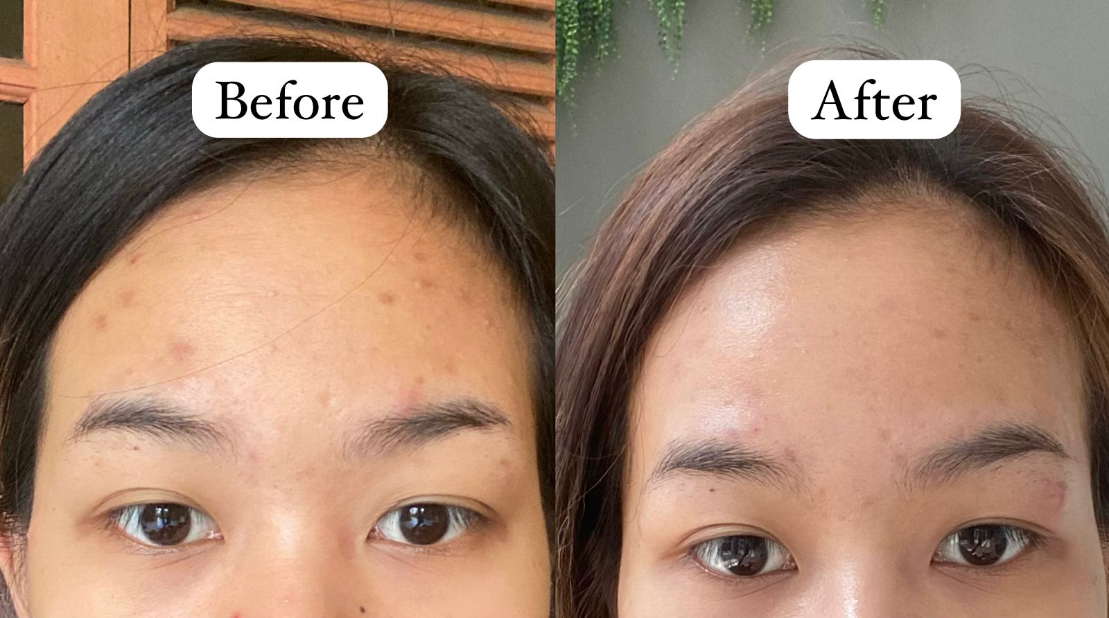 Mederma advanced gel